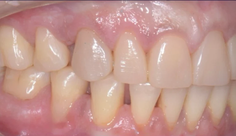 Faccette Dentali 36 Io Sorrido - Studio Dentistico a Borgoricco