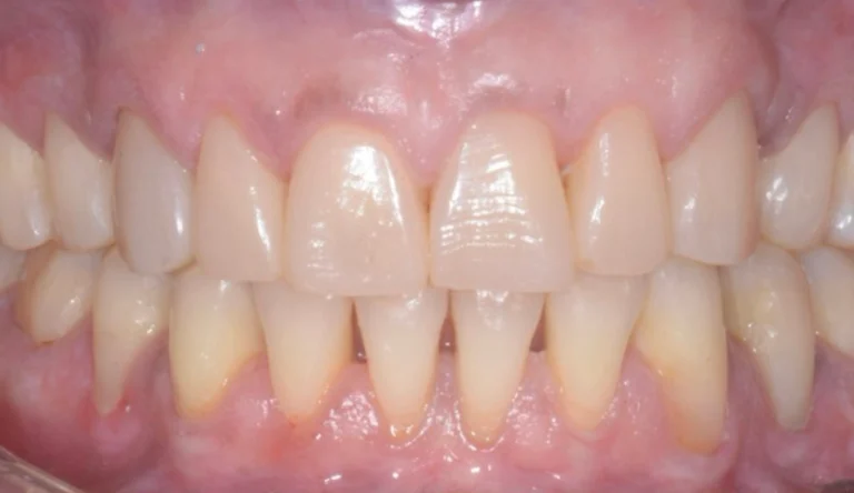 Faccette Dentali 38 Io Sorrido - Studio Dentistico a Borgoricco