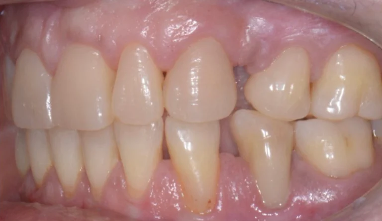Faccette Dentali 40 Io Sorrido - Studio Dentistico a Borgoricco