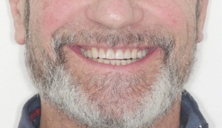 Faccette Dentali 60 Io Sorrido - Studio Dentistico a Borgoricco