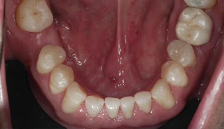 Faccette Dentali 56 Io Sorrido - Studio Dentistico a Borgoricco