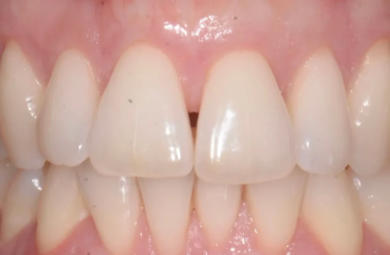 Parodontologia 12 Io Sorrido - Studio Dentistico a Borgoricco