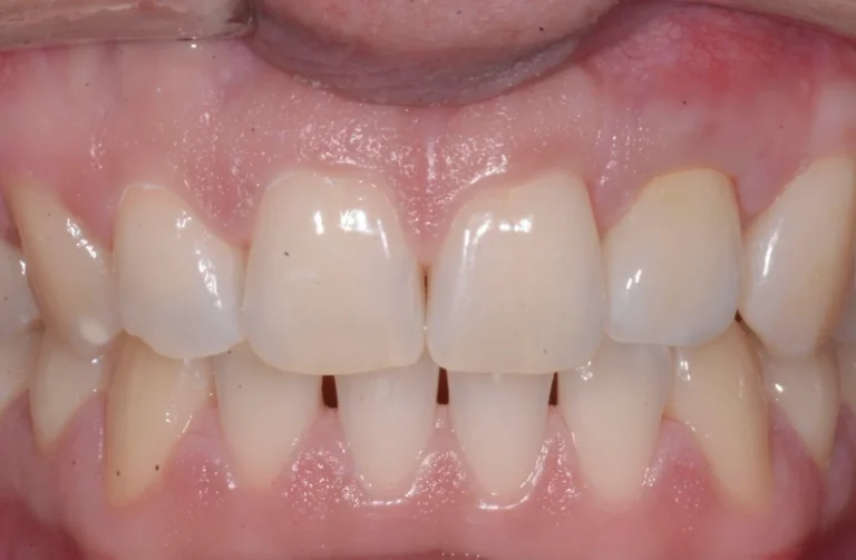 Parodontologia 14 Io Sorrido - Studio Dentistico a Borgoricco