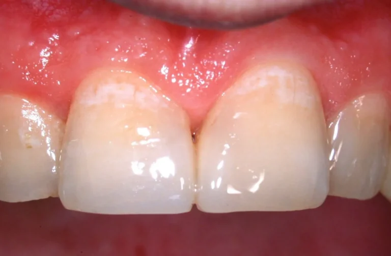 Conservativa 12 Io Sorrido - Studio Dentistico a Borgoricco