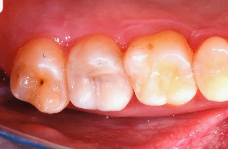 Conservativa 14 Io Sorrido - Studio Dentistico a Borgoricco
