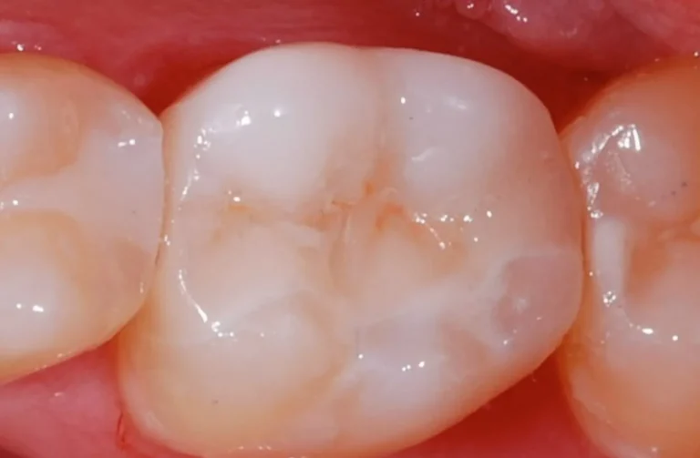 Conservativa 16 Io Sorrido - Studio Dentistico a Borgoricco