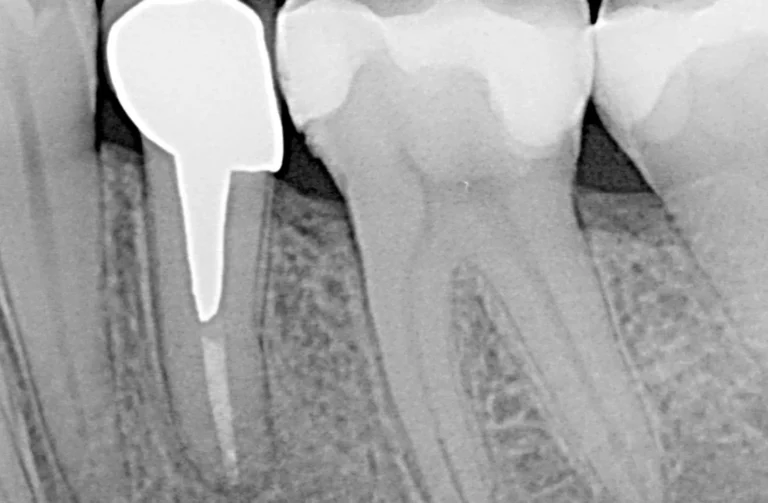 Endodonzia 12 Io Sorrido - Studio Dentistico a Borgoricco