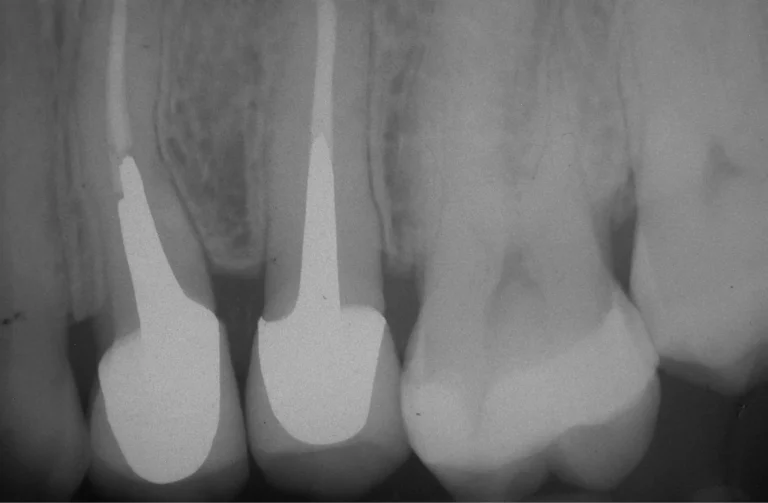 Endodonzia 14 Io Sorrido - Studio Dentistico a Borgoricco
