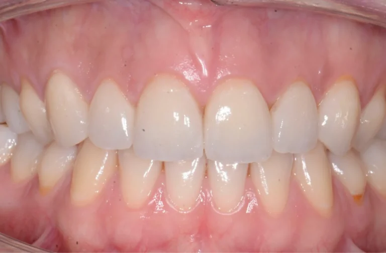 Faccette Dentali 14 Io Sorrido - Studio Dentistico a Borgoricco