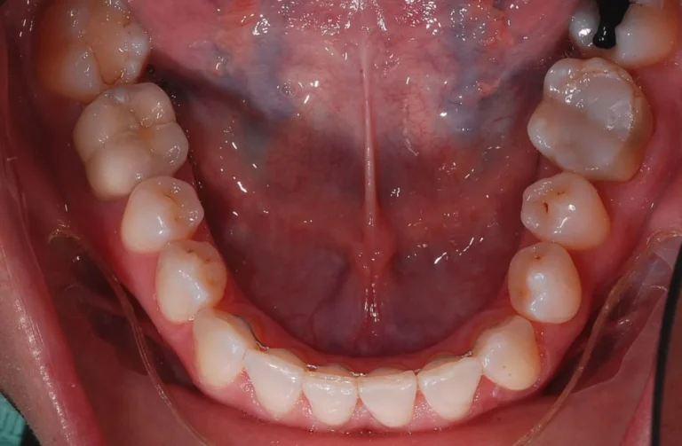 Ortodonzia trasparente 12 Io Sorrido - Studio Dentistico a Borgoricco