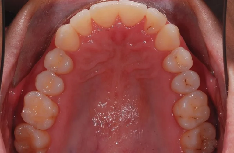 Ortodonzia trasparente 14 Io Sorrido - Studio Dentistico a Borgoricco