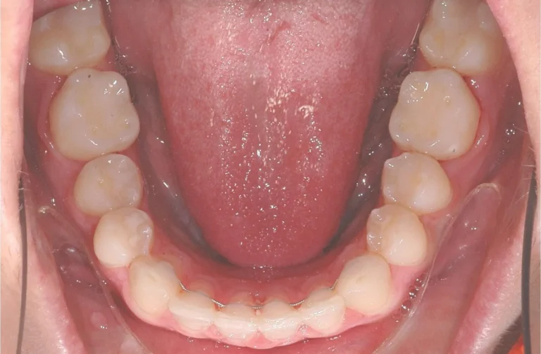Ortodonzia trasparente 16 Io Sorrido - Studio Dentistico a Borgoricco