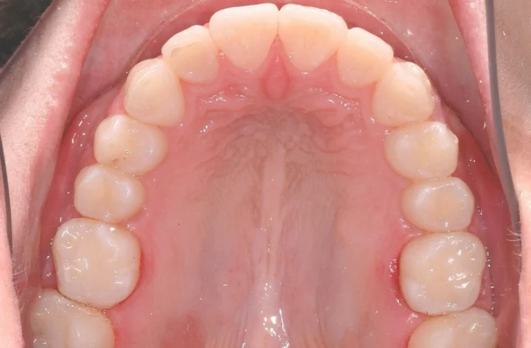 Ortodonzia trasparente 18 Io Sorrido - Studio Dentistico a Borgoricco