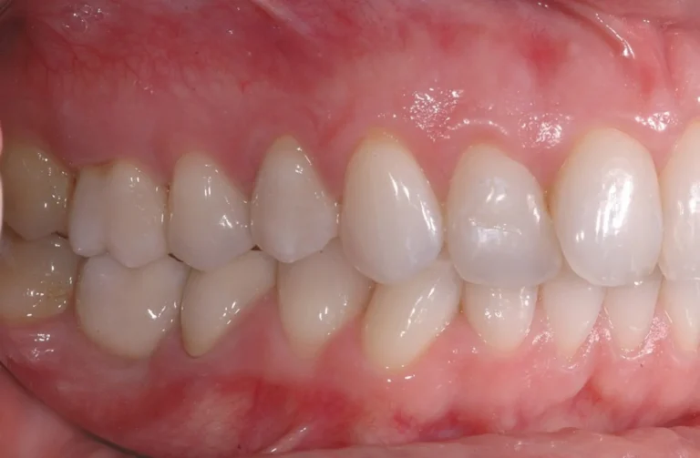 Protesi 12 Io Sorrido - Studio Dentistico a Borgoricco
