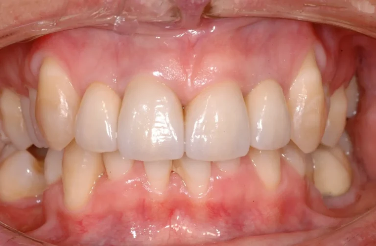 Protesi 14 Io Sorrido - Studio Dentistico a Borgoricco