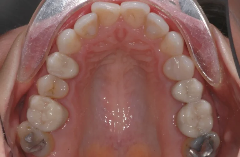 Protesi 16 Io Sorrido - Studio Dentistico a Borgoricco