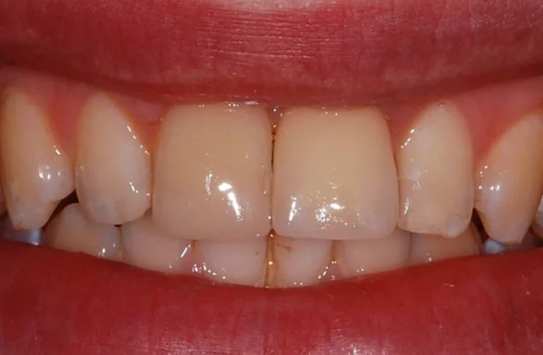 Protesi 18 Io Sorrido - Studio Dentistico a Borgoricco