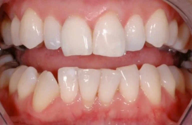 Sbiancamento 12 Io Sorrido - Studio Dentistico a Borgoricco